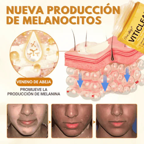 VitiClear Pro Crema de veneno de abeja ANTI-MANCHAS